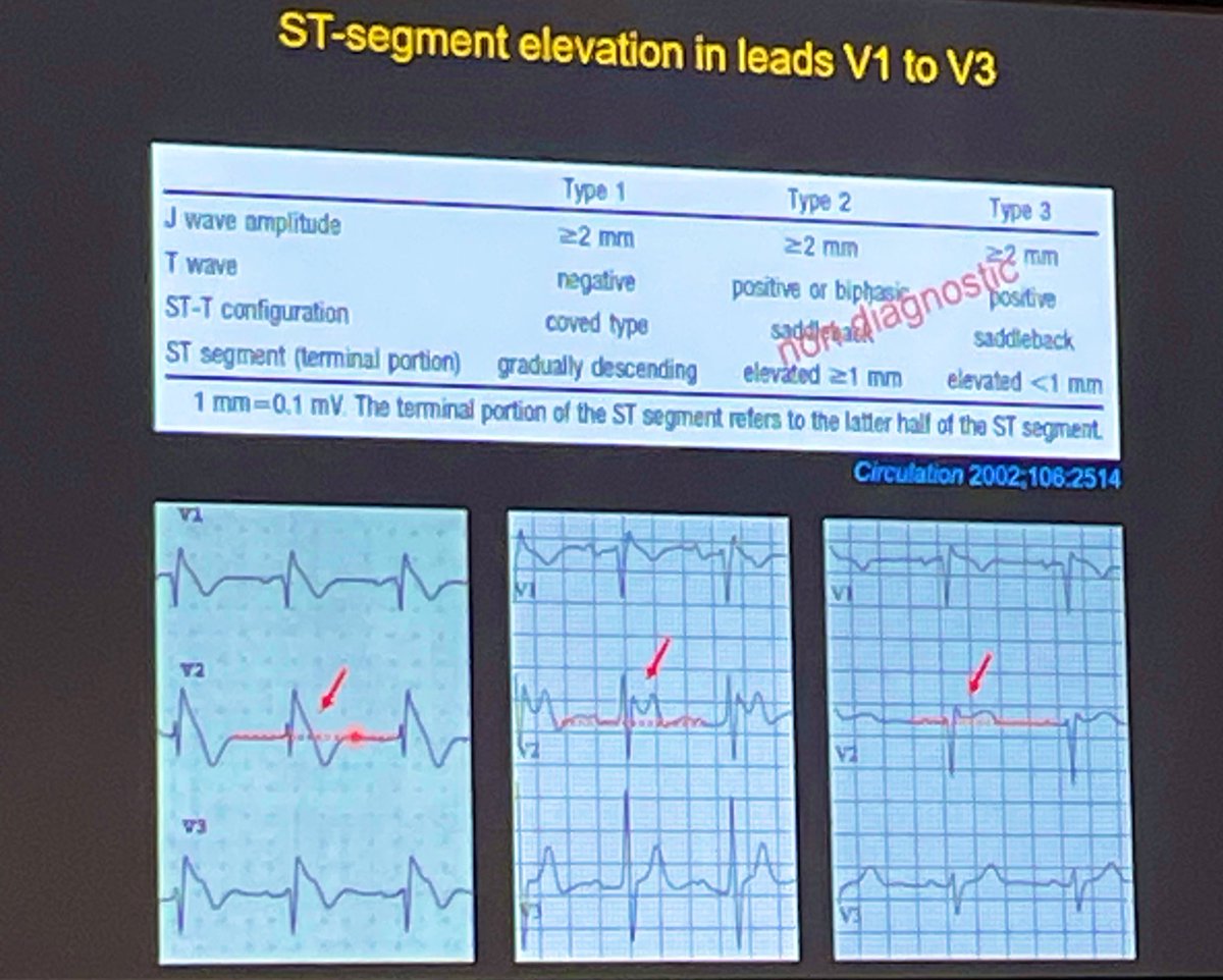 Prof. Brugada: „Please don‘t talk to Pts about Brugada-Syndrome if you don‘t have a type 1 ECG! 5 seconds later they‘ll be on the internet, 2 minutes later they‘ll have found my email“ 😂 Do provocation testing (Ajmalin challenge) in nondiagnostic ECG. #EUSEM2023