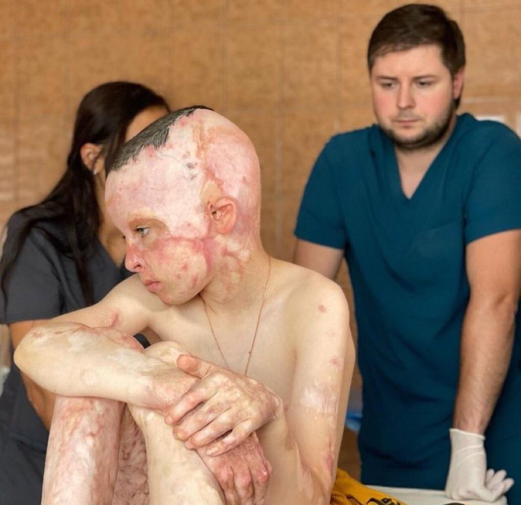 8-year-old Roman suffered severe burn wounds on 45% of his body from a Russian missile strike on a medical center in Vinnytsia last summer. All Russian war criminals must be prosecuted!