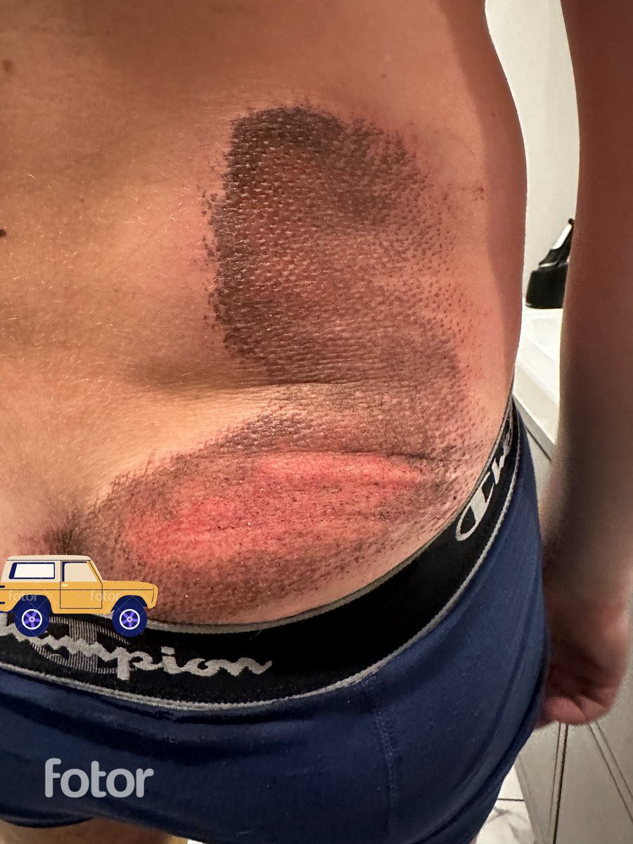 Teeghman's tweet photo. I am slowly recovering from the worst hit-and-run of my life, and I feel genuinely lucky to be alive. I was biking home from a show Friday night in the *unprotected* bike lane on Halsted, and this is some of the aftermath.
🧵
#chibike #bikechi https://t.co/v2uxjw0qpK