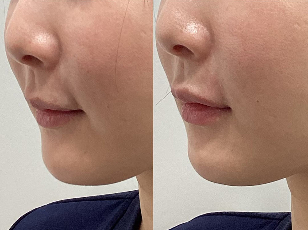 cocobeauty99's tweet photo. サーマジェンの人中短縮レーザーが話題だけど個人的にはやった事もある「フォトナ6D」がおすすめかな

症例画像エグすぎん？

表面からと口の中からによるサンドイッチ照射ができるのが何よりも強み。1回でも唇はヒアル入れたみたいにプルッとなって人中を短くさせる。

上唇も下唇もふっくら。施術時の痛みはなくてダウンタイムもない。