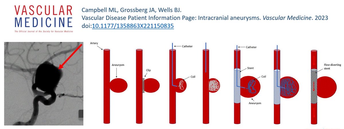 From the latest issue: Our “Patient Information Page” on intracranial aneurysms by @The_Doc_Martin et al. provides an excellent resource for both patients and providers. @wellsbryanj @emoryheart buff.ly/3Zk5iJR