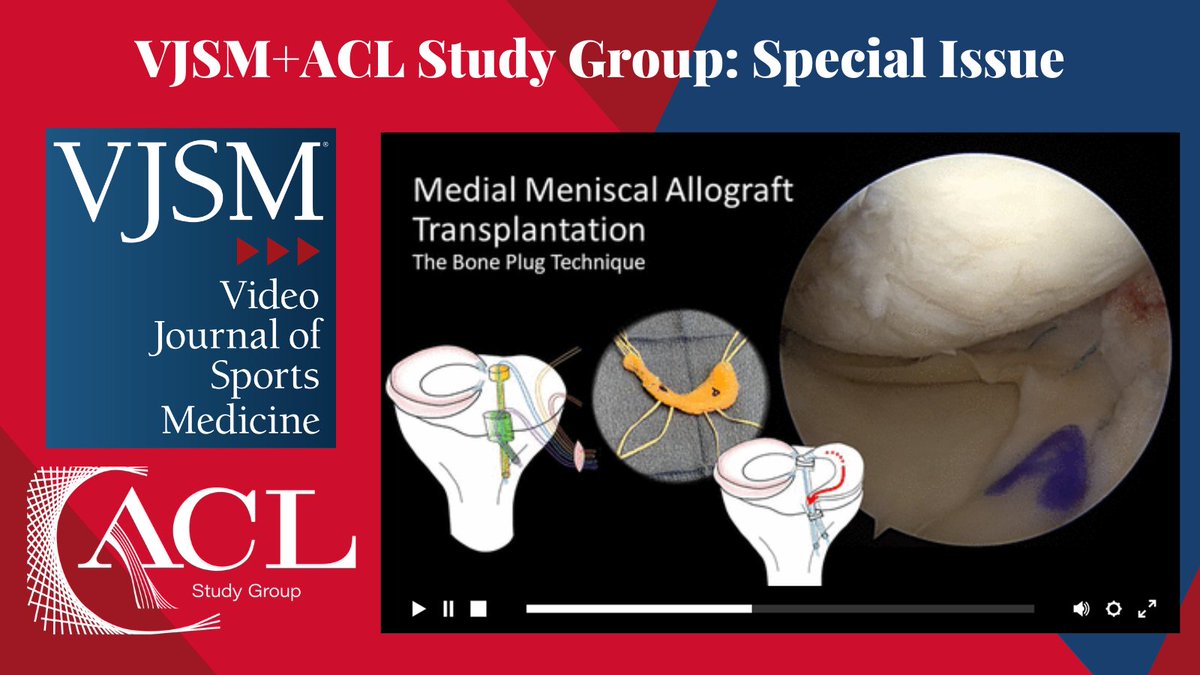 videojsportsmed's tweet photo. New from the @ACLStudyGroup Group Special Issue: @SethLShermanMD et al highlight the importance of working with graft size during medial meniscus allograft transplantation! #ACLStudyGroupVJSM
Check it out: https://t.co/YeOlW144Ir https://t.co/F4LeRYL3Qb