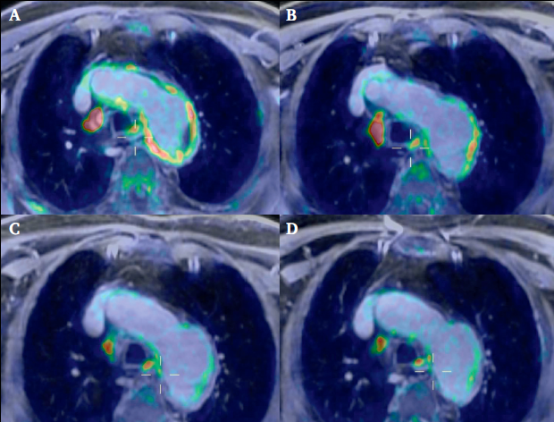 EJVES_ESVS's tweet photo. #EJVESopenaccess 09/23 - "Longitudinal Assessment of Inflammatory Activity in Acute Type B AD with Integrated Fluorodeoxyglucose PET-MR Imaging", w/ more inflammatory changes observed in patients requiring interventions @AWanhainen @KevinMani7 #AortaEd

🌐 https://t.co/0eIKJlLsgJ https://t.co/otChrybEdi