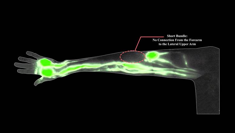 Boston Breast Surgeon (@drtedjames) on Twitter photo Why do only some women develop lymphedema after an ALND? Our work with the lymphatics team aims to identify anatomical risk factors to better understand susceptibility to breast cancer-related lymphedema.
<a href="/DrDhruvSinghal/">Dr. Dhruv Singhal</a>
#breastcancer
#lymphedema
tinyurl.com/5at6rf78 Why do only some women develop lymphedema after an ALND? Our work with the lymphatics team aims to identify anatomical risk factors to better understand susceptibility to breast cancer-related lymphedema.
<a href="/DrDhruvSinghal/">Dr. Dhruv Singhal</a>
#breastcancer
#lymphedema
tinyurl.com/5at6rf78
