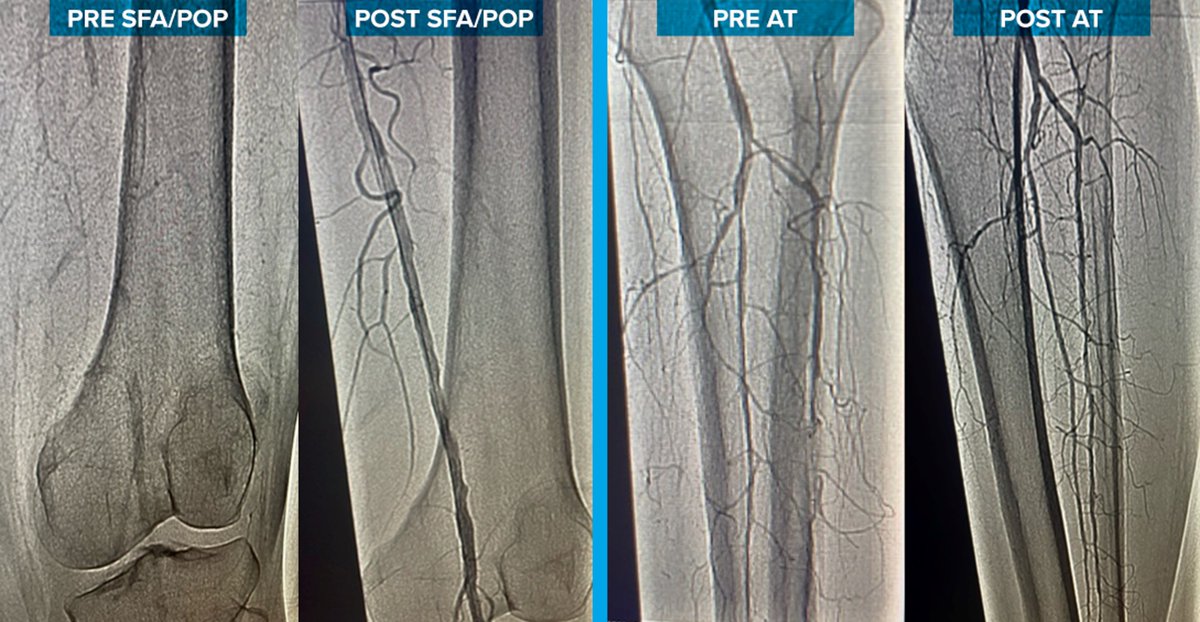 ShockwaveIVL's tweet photo. Dr Subbarao Yarra at @DHRhealth treated a 50 yo female w/ chronic renal failure & severe claudication pain. Dr Yarra used #ShockwaveM5Plus at the distal SFA/Pop & a DCB. Then, standalone #ShockwaveS4 was used at the AT for a great result.
US Rx only. ISI https://t.co/sZ0NdzXNcV https://t.co/sRwDItS8Jc