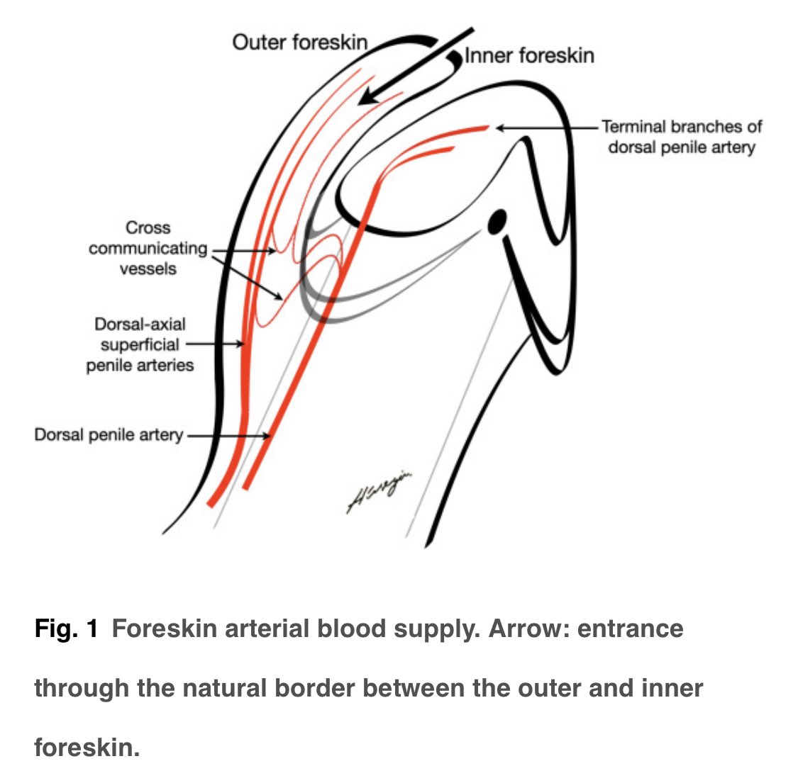 huseyinozbey13's tweet photo. Anatomical modeling of the foreskin for the reconstruction of glanular hypospadias #hypospadias #septumglandis #fossanavicularis @uroweb @ESPUorg @urotoday @ESRUrology @essm_tweets
https://t.co/PowiJRYKxR https://t.co/EQXsgBXsPF