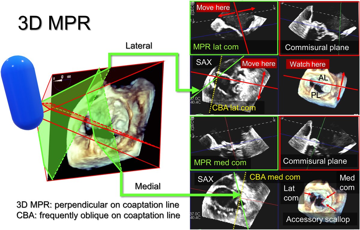 How good can the commissural biplane approach (CBA) be in assessment of this complex mitral valve anatomy? Read our @JournalASEcho article, 'Biplane Imaging: In the Land of the Blind, the One-Eyed Man Is King!' bit.ly/46dfxSC