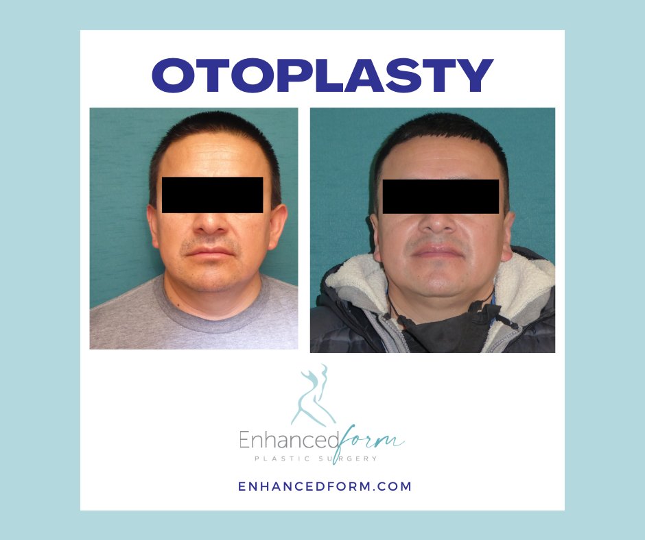 EnhancedForm's tweet image. Redefining your ears can be the subtle yet powerful change you've been seeking. Otoplasty works wonders! Call us today at 847-297-8001 to schedule an appointment. 📷 #SubtleTransformation #Otoplasty #EarTransformation #Confidence #PlasticSurgery #Surgery #PlasticSurgeryProcedure