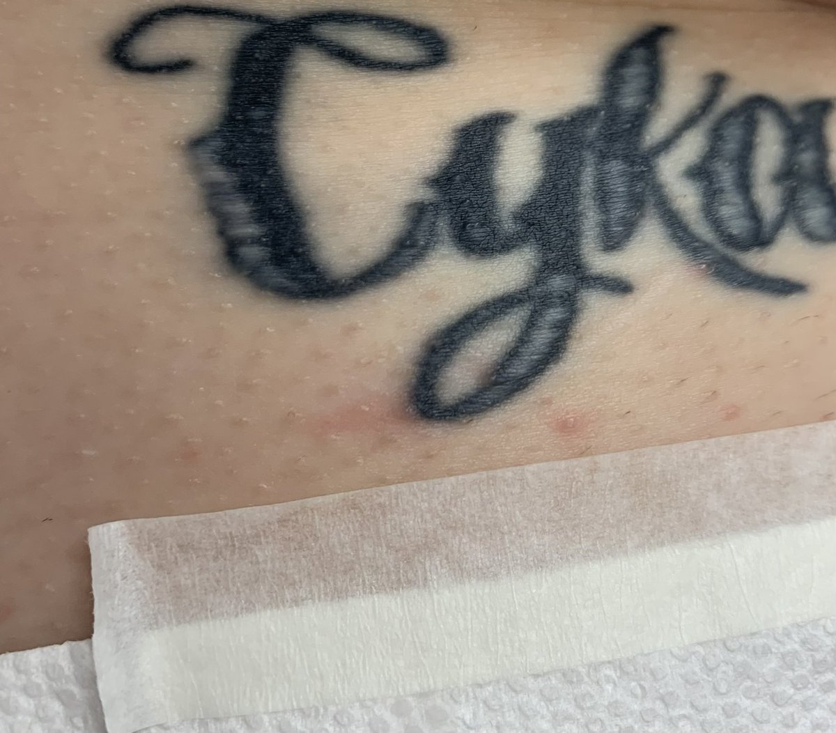 dootsandhoops's tweet photo. before and after of first tattoo removal lol https://t.co/p0VXkm4UO2