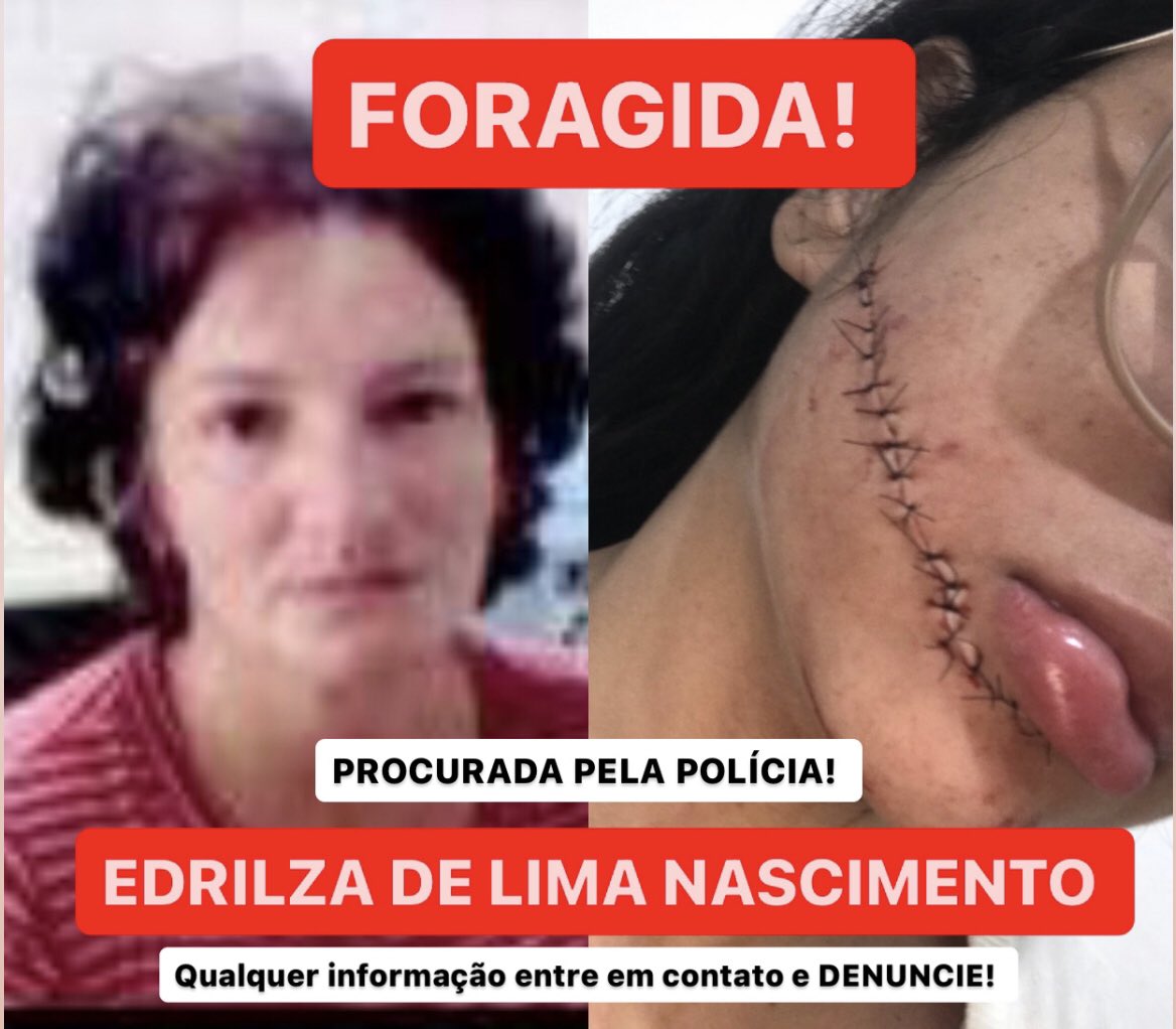 tezinha_firmo's tweet photo. A CRIMINIOSA ESTÁ FORAGIDA! ME AJUDE COMPARTILHANDO ESSE POST. 

Há 9 meses fui vítima de um atentado dentro de um ônibus enquanto eu dormia, essa mulher me agrediu com uma faca e o corte levou 18 pontos. A lesão foi grave e a decisão judicial foi expedir um MANDADO DE PRISÃO PRE https://t.co/kUCfnT2tVN
