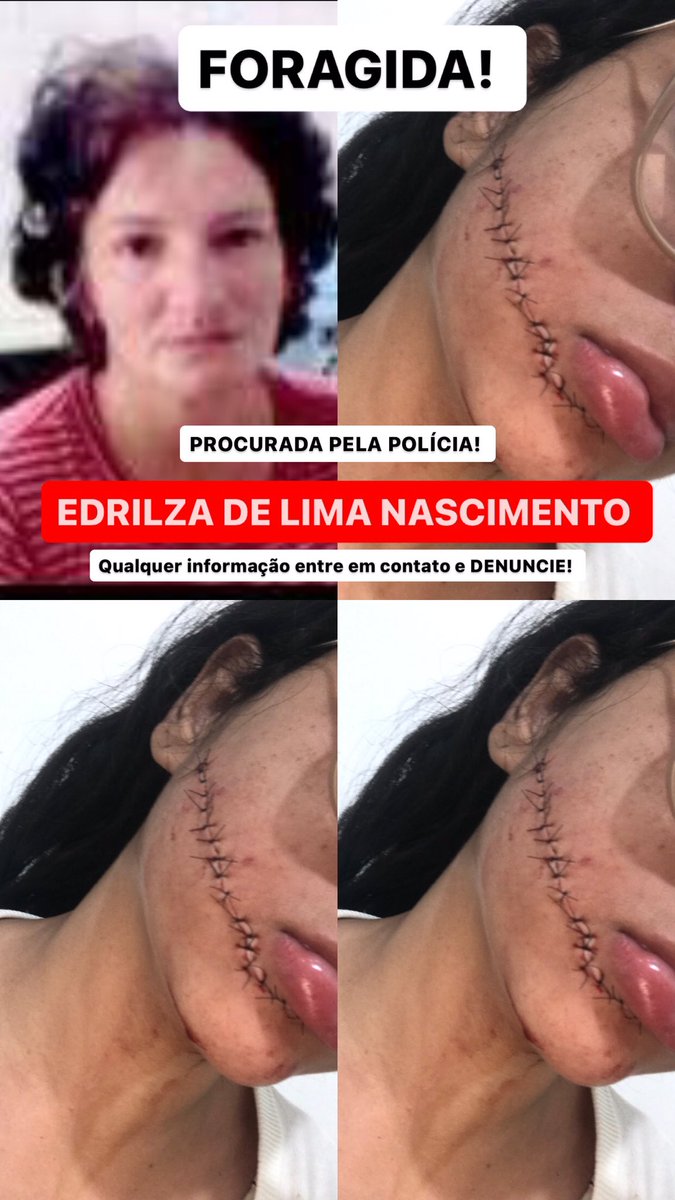 tezinha_firmo's tweet photo. A CRIMINIOSA ESTÁ FORAGIDA! ME AJUDE COMPARTILHANDO ESSE POST. 

Há 9 meses fui vítima de um atentado dentro de um ônibus enquanto eu dormia, essa mulher me agrediu com uma faca e o corte levou 18 pontos. A lesão foi grave e a decisão judicial foi expedir um MANDADO DE PRISÃO PRE https://t.co/kUCfnT2tVN