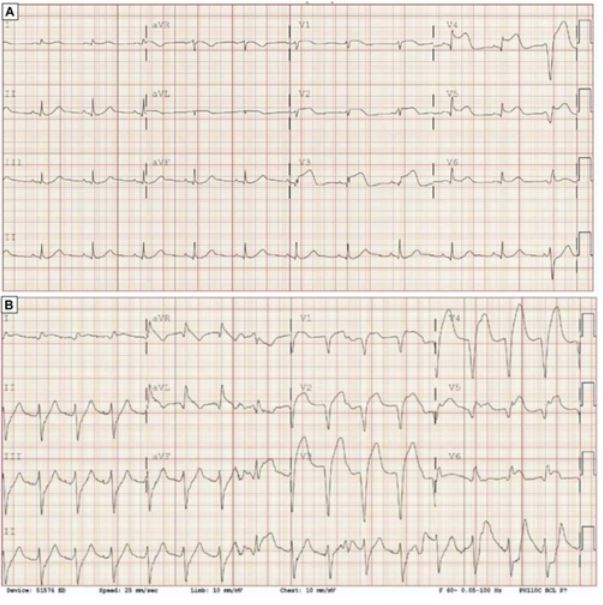 #ECGChallenge: Chest pain, bundle branch block, and wide complex tachycardia: Is three a company or a crowd? @durstenfeld #AHAJournals ahajournals.org/doi/10.1161/CI…