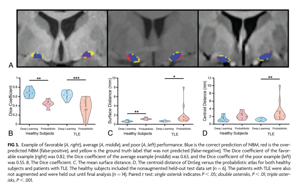 AJNR (@theajnr) on Twitter photo "Deep Learning Segmentation of the Nucleus Basalis of Meynert on 3T MRI" #DeepLearning #OpenAccess <a href="/DerekDoss/">Derek Doss</a> | bit.ly/3EJ4XXN "Deep Learning Segmentation of the Nucleus Basalis of Meynert on 3T MRI" #DeepLearning #OpenAccess <a href="/DerekDoss/">Derek Doss</a> | bit.ly/3EJ4XXN