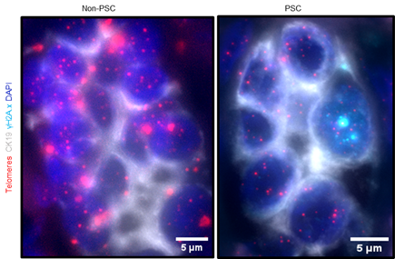 MCTransplntSurg's tweet photo. Recent work by Dr. @NJSakrikar and Dr. @rhuebert demonstrate a mechanistic role for #telomere dysfunction in the cellular senescence and #biliaryfibrosis that characterize Primary Sclerosing Cholangitis. #PSC #MedTwitter #TransplantTwitter
https://t.co/gMdUlZXE92 https://t.co/QMMGvDYuOM