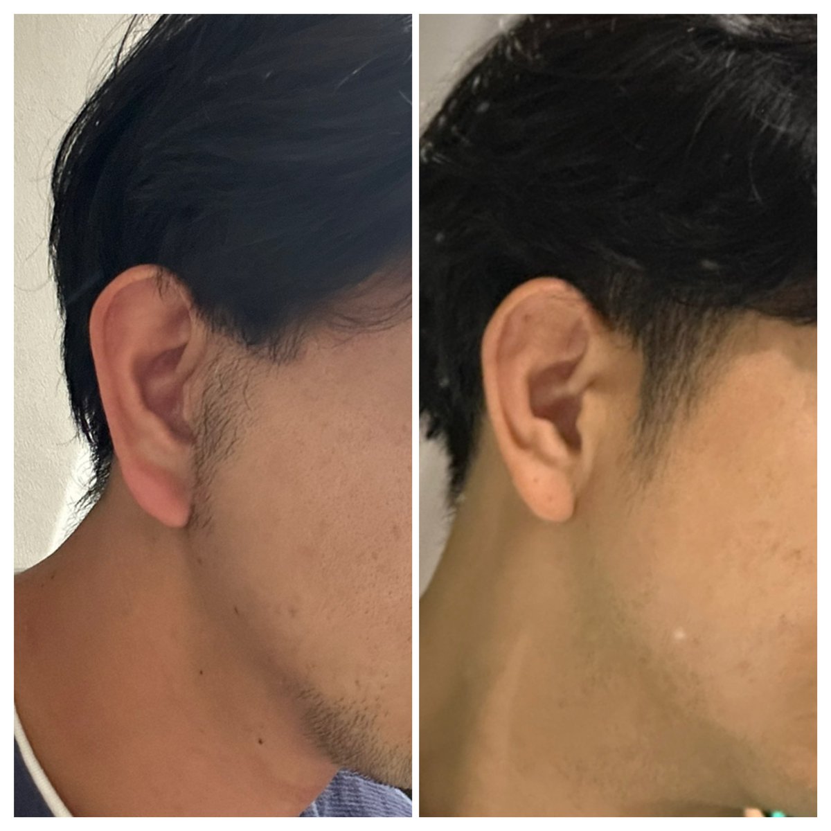 知り合いの方が切開リフト後のもみあげ気にしていたので

自分のを見たら

もみあげ後ろにズレてるやん

毛が生えてきてないやん

これはビビる

どうなるか

#rex 
#切開リフト 
#バッカルファット 
#メーラーファット
#整形垢 
#韓国 
#整形
#ANA
#voco
#ダウンタイム
#メンズ美容
#もみあげ