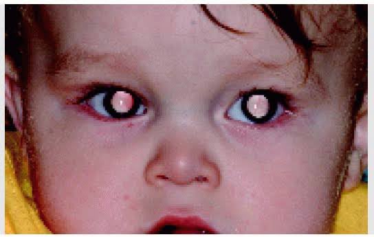 Satyayadav__'s tweet image. 19 Sept 23 

Once you get tumor in one eye or one kidney can it occur in other eye or other kidney?

Yes!

#Retinoblastoma can happen in both eyes at same time or one followed by other 

#WilmsTumor can also affect both kidneys

#ChildhoodCancerAwarenessMonth 

#GoldSeptember