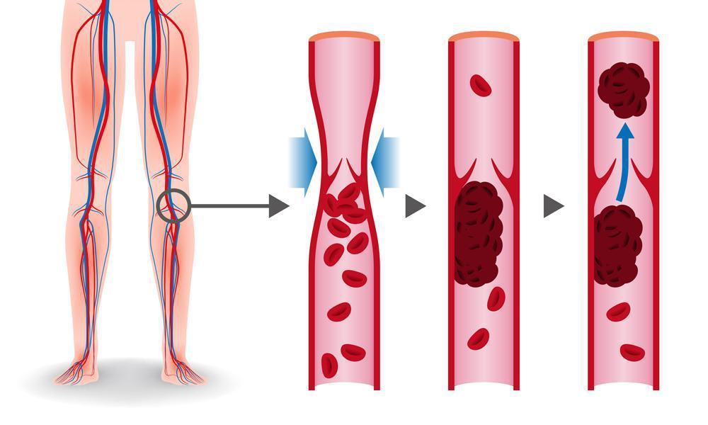 '🩸#Thrombosis: A critical topic in #CardiovascularMedicine. Stay updated with cutting-edge research in the Journal of Cardiovascular Medicine and Therapeutics. Explore clotting, prevention, and treatment. 📚 #Cardiology #Research #MedicalScience'
