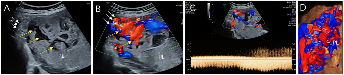 CEOGjournal's tweet photo. Ling Zhang. Application Value of #Sonographic Scoring Method in the Diagnosis of Singleton #Angular_Pregnancy and #Angular_Villi or #Placenta_Accrete.
It has been published in @CEOGjournal at https://t.co/Lj3koZdkQT
Welcome to your reading! https://t.co/OrYVbHXKdH