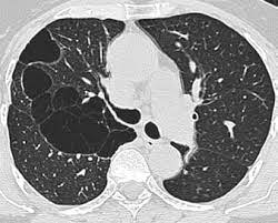 jimmunoallerg's tweet photo. Birt–Hogg–Dubé syndrome (BHD) is a rare inherited autosomal dominant disorder caused by germline mutations in the tumor suppressor gene FLCN, encoding the protein folliculin.
#Birtsyndrome #pneumothoraces #fibrofolliculomas #immunology #mutations #pulmonarycysts #histopathologic https://t.co/rK6DV7jQcv