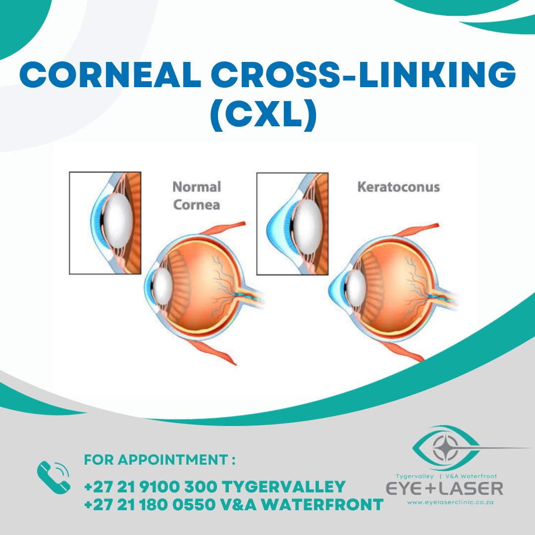 CXL: Stop keratoconus, improve vision, and avoid corneal transplantation.
#keratoconus #CXL
Contact us:
@eyeandlaserclinic @dr_johann_kruger 
📞 +27 21 9100 300 Tygervalley
📞 +27 21 180 0550 V&amp;A Waterfront