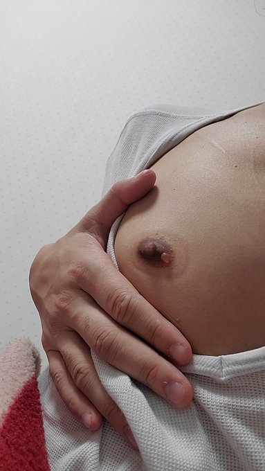 何か右の乳輪に水ぶくれ？が出来ててどうしよう&hellip;ってなってる これは一旦放置しといた方がいいんだろうか？ https://t.co/qAoM1gb4sY<a href="/tag/%E5%A4%89%E6%85%8B"class="tags"><span>#変態</span></a><a href="/tag/%E5%85%A8%E8%A3%B8"class="tags"><span>#全裸</span></a>