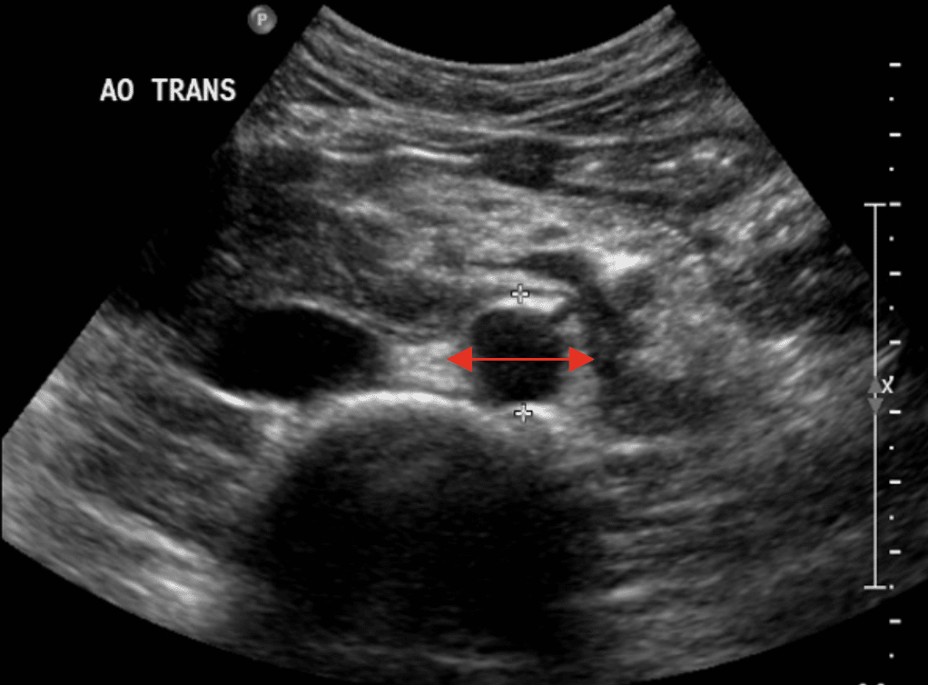 LITFLblog's tweet photo. Master the POCUS AAA scan! 🩺
Scan aorta from diaphragm to bifurcation. Save at max diameter. AAA = >3cm AP dia.  
Click here to learn more ➡️ https://t.co/zvGZne2e1b

#POCUS #MedEd #FOAME #MedTwitter #AAA https://t.co/dgPKBZVM27