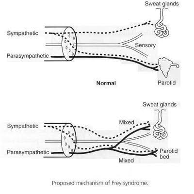lFzRl's tweet photo. #Frey's Syndrome is a #syndrome that includes sweating while #eating (#gustatory #sweating) and #Facial #flushing. It is caused by #injury to a nerve, called the #auriculotemporal #nerve, typically after #surgical #trauma to the #parotid #gland.

#MedTwitter
#medical #healthcare https://t.co/xfka8K2VUp