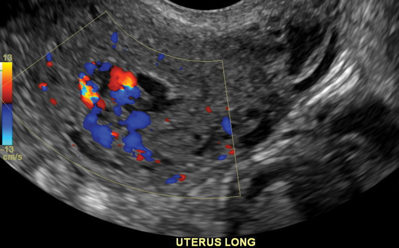 Exploring the landscape of Uterine Vascular Anomalies: A comprehensive guide to management and treatment options. thieme-connect.com/products/ejour… AUTHOR: @MonicaMatsumoto #WomensHealth #Gynecology #MedicalResearch #Womeninmedicine