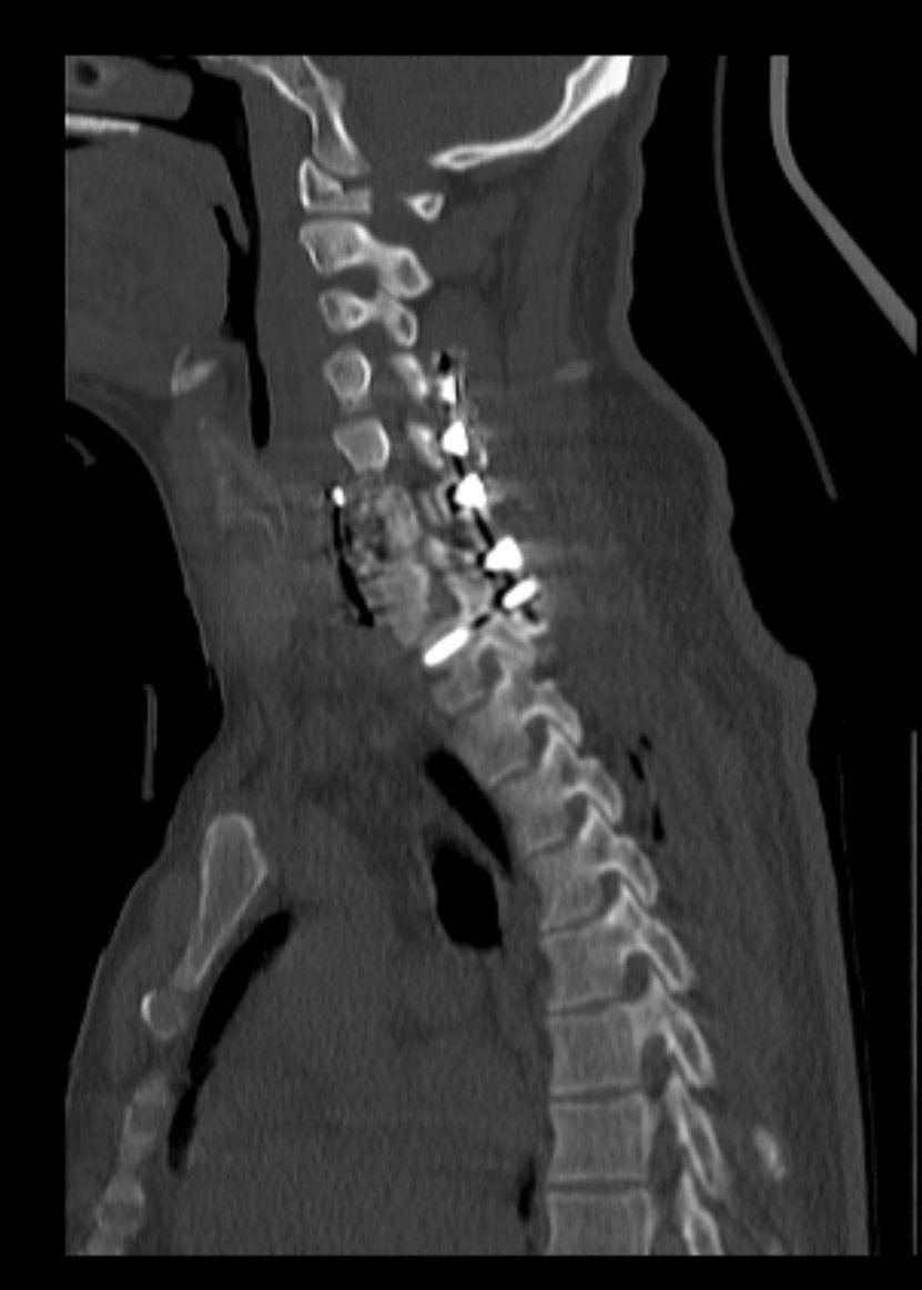 mo_ma1374's tweet photo. Following the previous post, posterior fixation in C6 vertebra fracture... after anterior procedure... https://t.co/6hZ38wSRI5