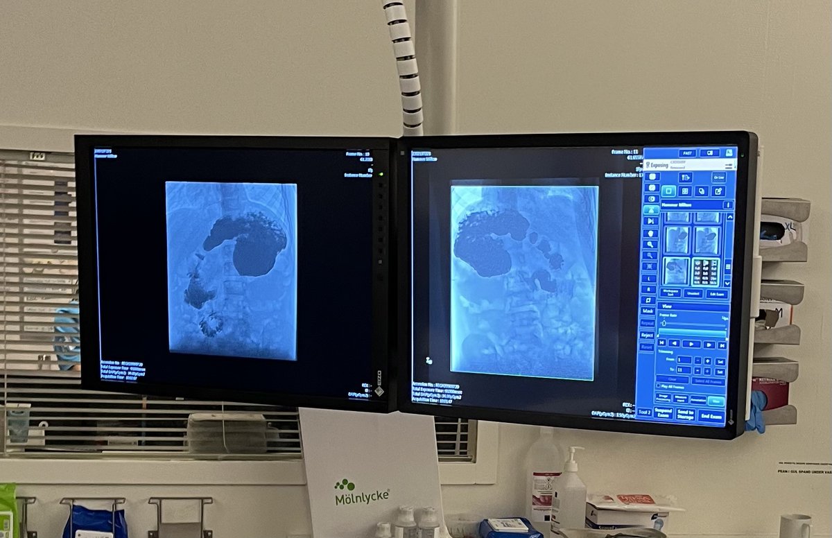 Pediatric Surgery Friends,

We have a 10 year old Congenital Diaphragmatic Hernia survivor in Europe who also has Mesentero-Axial Gastric Volvulus and is in much pain. He has had 1 surgery but his organs have flipped again.

Please message me if you are able to consult.