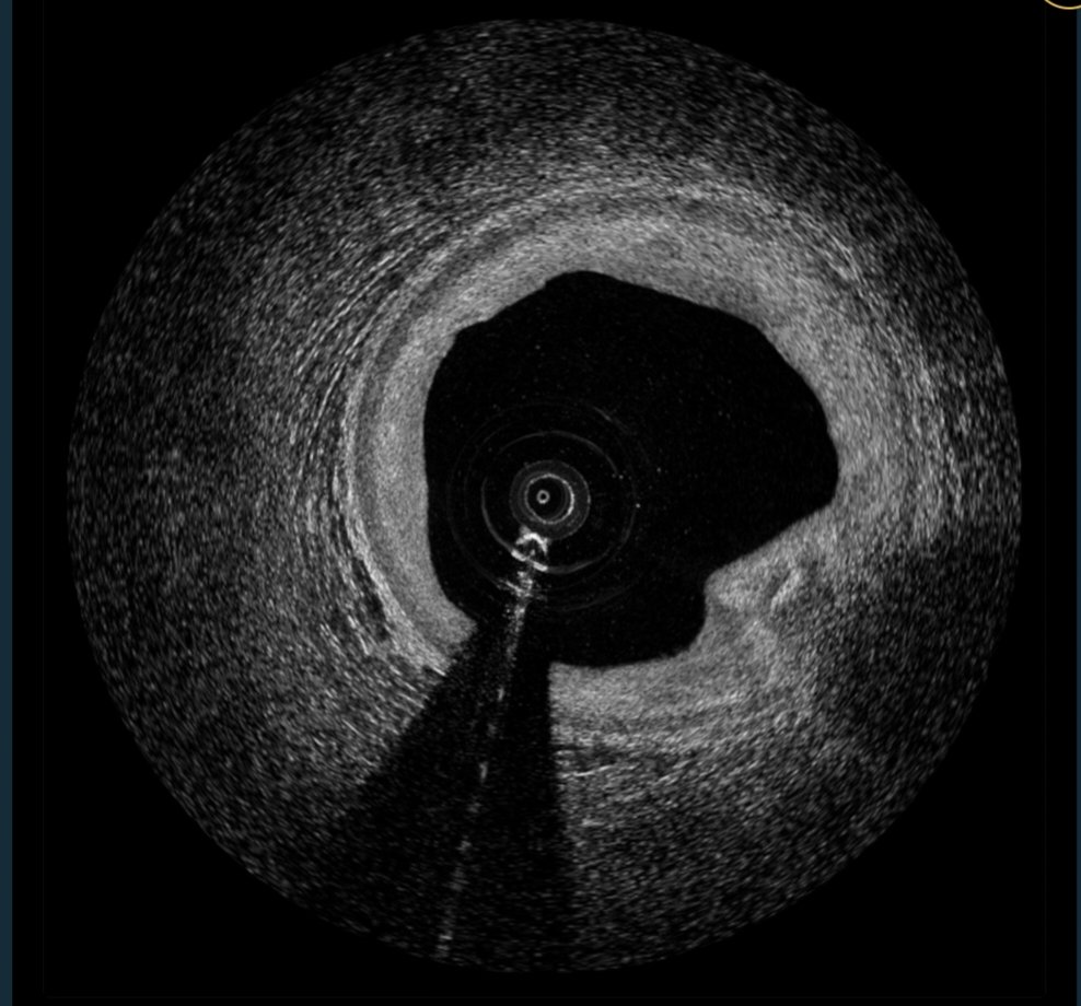 #TCT2023
@crfheart
@TCTConference
SpectraWAVE - HyperVue Imaging System

This system combines SpecraWave’s next-generation DeepOCT images and near-infrared spectroscopy (NIRS) with ease of use to support physicians optimizing coronary stenting in the cardiac cath  lab.