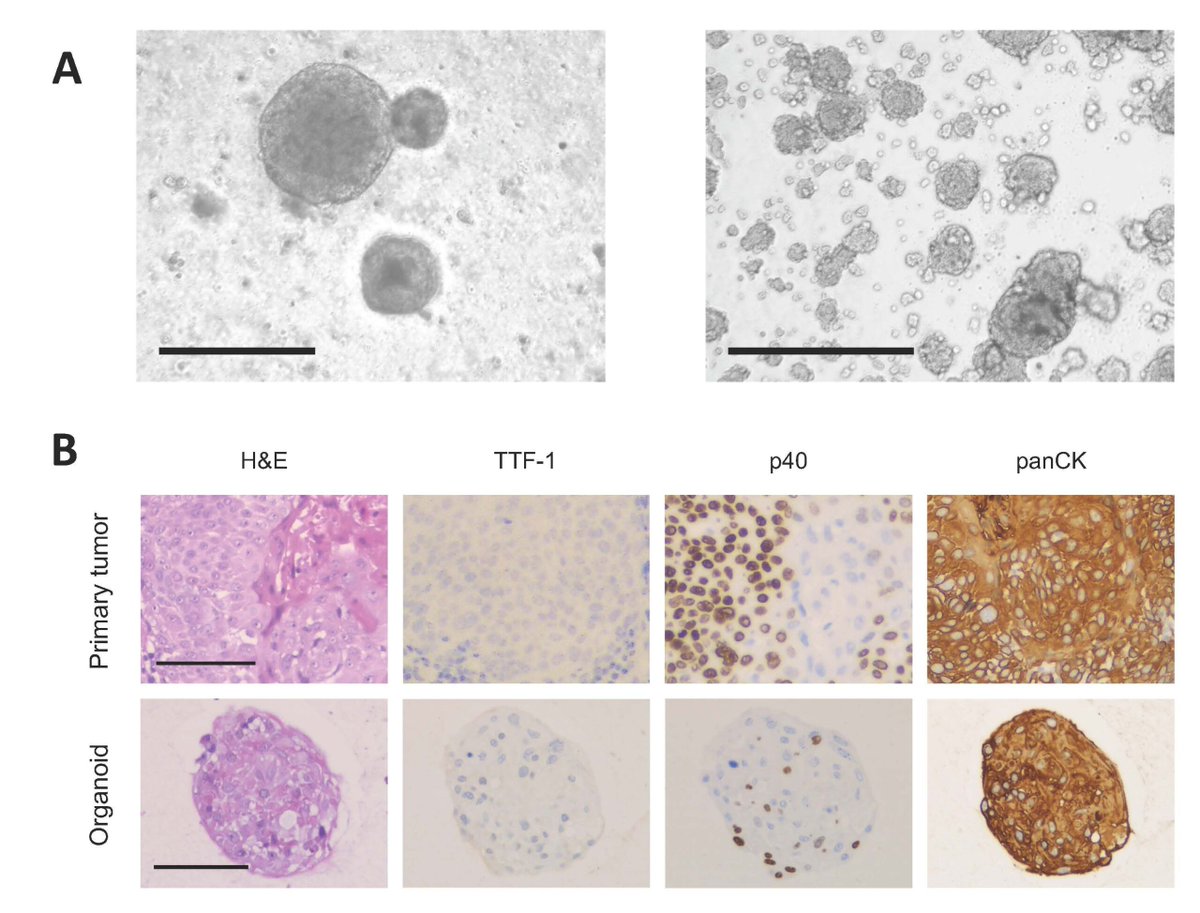 Primäre #Organoide, 3D-Zellkulturen aus Tumorgewebe, helfen, die Vorgänge in Krebszellen besser zu verstehen und wirksamere Therapien zu entwickeln. Das #USZ gehört zu wenigen Zentren weltweit, die mit diesen Modellen forschen: scomp.ly/organoid #Lungenkrebs #Forschung