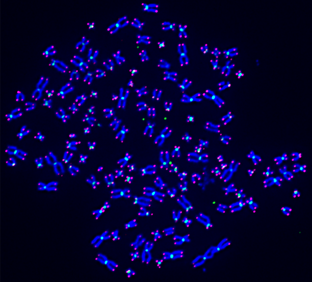 Frank Mason (@frank_m_mason) on Twitter photo Excited to share our latest publication in @PNAS with <a href="/KimrynRathmell/">Kimryn Rathmell</a> where we demonstrate that mutation or inhibition of the tumor suppressor SETD2 promotes the formation of a whole host of chromsosomal aberrations including isochromosomes pnas.org/doi/10.1073/pn⊠𧔠Excited to share our latest publication in @PNAS with <a href="/KimrynRathmell/">Kimryn Rathmell</a> where we demonstrate that mutation or inhibition of the tumor suppressor SETD2 promotes the formation of a whole host of chromsosomal aberrations including isochromosomes pnas.org/doi/10.1073/pn⊠đ§”