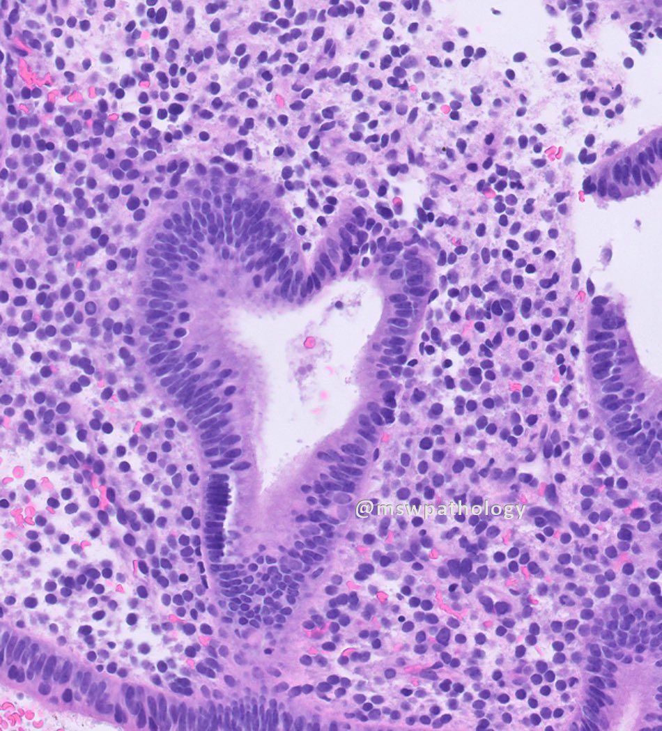 MSWPathology's tweet photo. A lovely endometrial gland spotted by our PGY-2 @3abeer_Mahmoud ☺️💘 https://t.co/IluObsyBkp