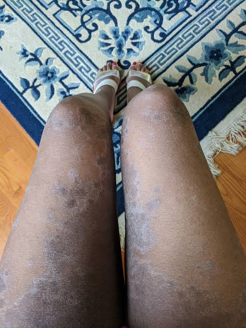 Nig_Farmer's tweet image. #NaijaFarmerTips

Do you have Skin Irritation, Eczema, Ringworm, Pimples, Rashes?

Rice Water is the Solution!

Soak Rice In a container for 2-3 days... Sieve Out the Water

Apply the water in the affected parts. Leave for 30mins - 1hr bfr washing off

All Skin Irritation gone!