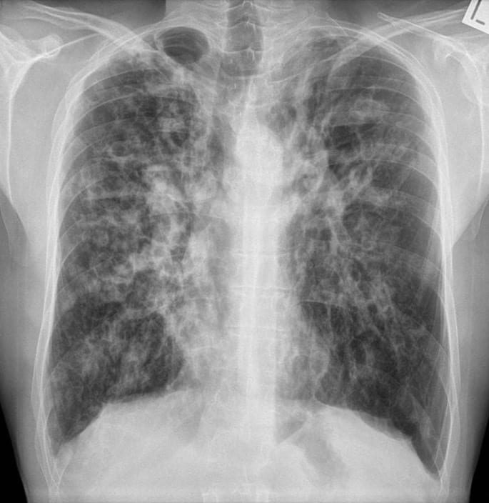 ItsInfusion's tweet photo. A 22 yo male presents with worsening chronic cough and breathlessness. He has been underweight since childhood.
Diagnosis??? https://t.co/IGF4etVyIG