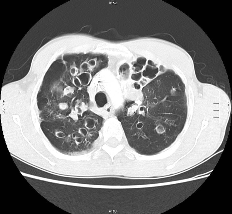 ItsInfusion's tweet photo. A 22 yo male presents with worsening chronic cough and breathlessness. He has been underweight since childhood.
Diagnosis??? https://t.co/IGF4etVyIG