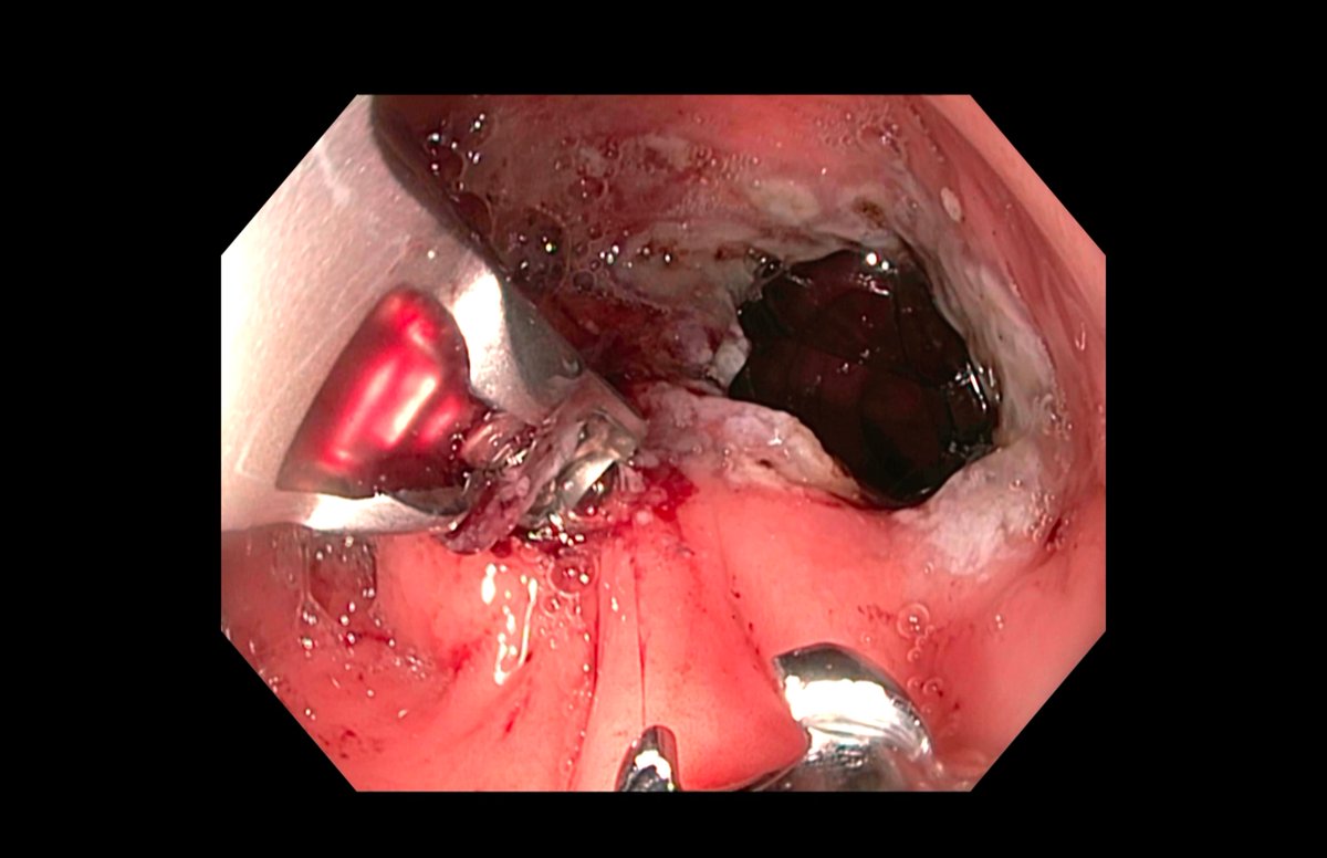 DigestivoVigo's tweet photo. "Un pequeño paso para el endoscopista... un gran salto para el tratamiento de las enfermedades metabólicas". 
Hemos realizado nuestro primer TORe con el método Apollo. 
Gracias a Boston Scientific y en especial al Dr. Andrés Del Pozo por guiarnos en esta nueva aventura. https://t.co/F50bLw8sFu