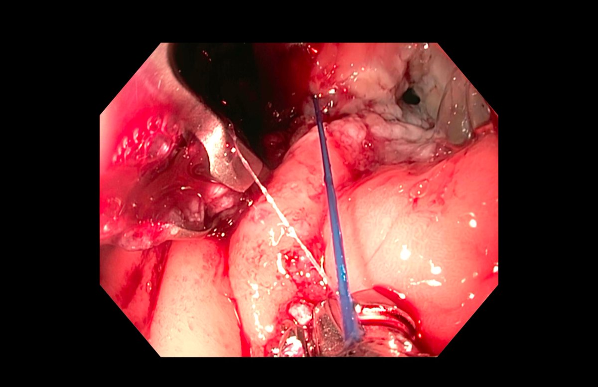 "Un pequeño paso para el endoscopista... un gran salto para el tratamiento de las enfermedades metabólicas". 
Hemos realizado nuestro primer TORe con el método Apollo. 
Gracias a Boston Scientific y en especial al Dr. Andrés Del Pozo por guiarnos en esta nueva aventura.