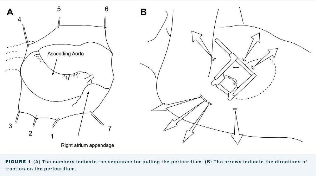 Matsumoto, Shimizu, & coauthors have performed Y incision and roof techniques for AVR through right infra-axillary thoracotomies & found that these procedures can be performed successfully by the Stonehenge technique. Read more: doi.org/10.1016/j.atss…  #OpenAccess #AnnalsImages