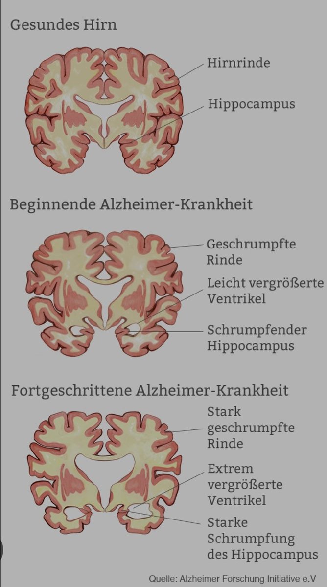 Bei einer Alzheimer-Krankheit lagern sich an den Nervenzellen zwei verschiedene Formen von Eiweißen ab. Diese Eiweißablagerungen blockieren den Informationsaustausch zwischen den Neuronen und führt zum Absterben der Nervenzellen.

#WeltAlzheimerTag
#mindblowingfacts