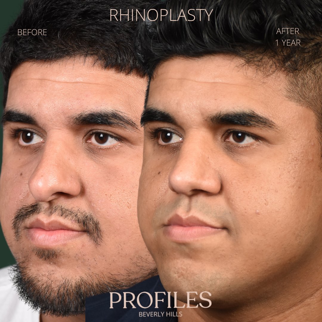 FacialPlastics's tweet photo. 📞310-276-6800
🏠 435 N Bedford Drive, PH500, Beverly Hills, 90210
👃Rhinoplasty
🗓 Before and After 1 Year / 6 Months
🛏 About 1 week, the cast gets taken off after 6 days

From before to 6 months to 1 year post-rhinoplasty.
Watch as the swelling takes a graceful journey downwar https://t.co/WY0POkF7pO