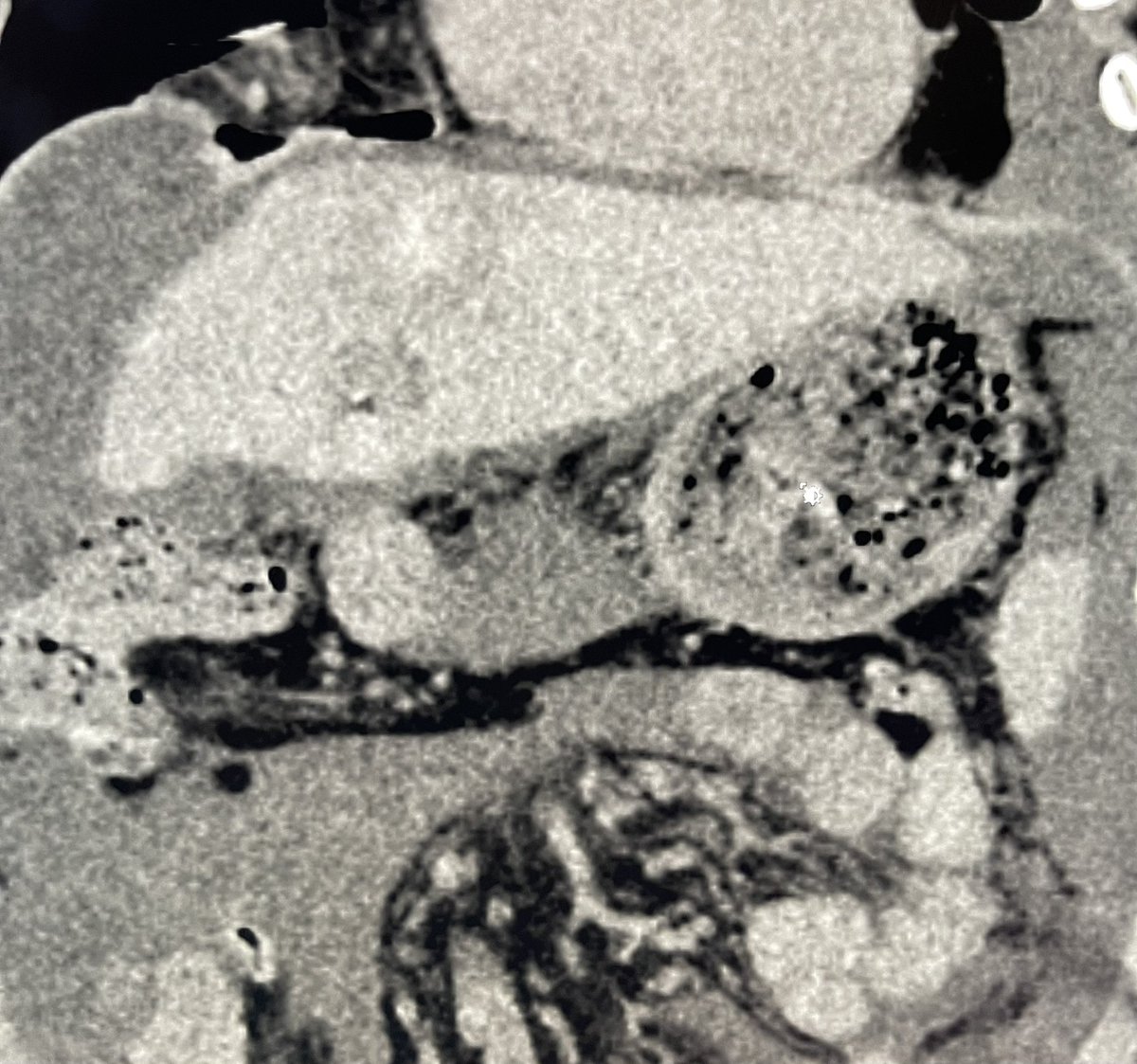 Ablation of left lobe heptocellular carcinoma HCC with good results @UTHouston_IR
#InterventionalRadiology #InterventionalOncology #minimallyinvasiveprocedures #IAmIR #HepatocellularCarcinoma #HVC #Cancer #Therapy #Management #GlobalEducation #ablation #LocalRegionalTherapy