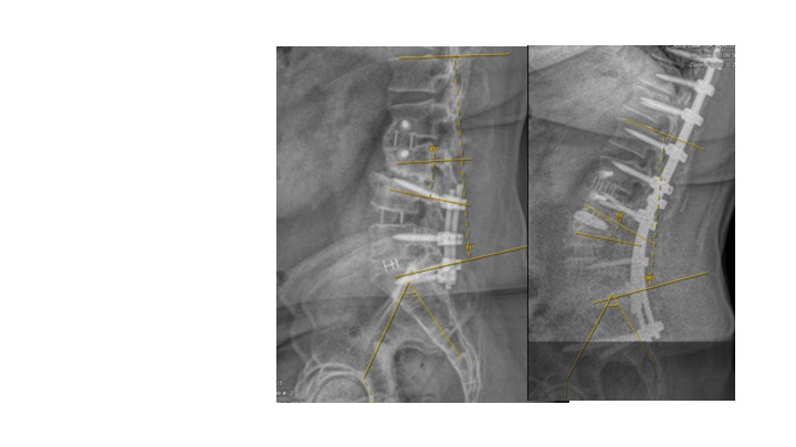 Muhammad Abd-El-Barr MD PhD FAANS (@abdelbarrspine) on Twitter photo Patient had L4-S1 fusion and L23 lateral elsewhere and was wheelchair bound.L3-4 PCO w/L34 prone lateral, L4 PSO with myself, Dr. Bhowmick <a href="/Dukeneurosurg/">Duke Neurosurgery</a> .He can now walk independently.The lines between open and MIS are becoming blurry and that's great for patients. Patient had L4-S1 fusion and L23 lateral elsewhere and was wheelchair bound.L3-4 PCO w/L34 prone lateral, L4 PSO with myself, Dr. Bhowmick <a href="/Dukeneurosurg/">Duke Neurosurgery</a> .He can now walk independently.The lines between open and MIS are becoming blurry and that's great for patients.