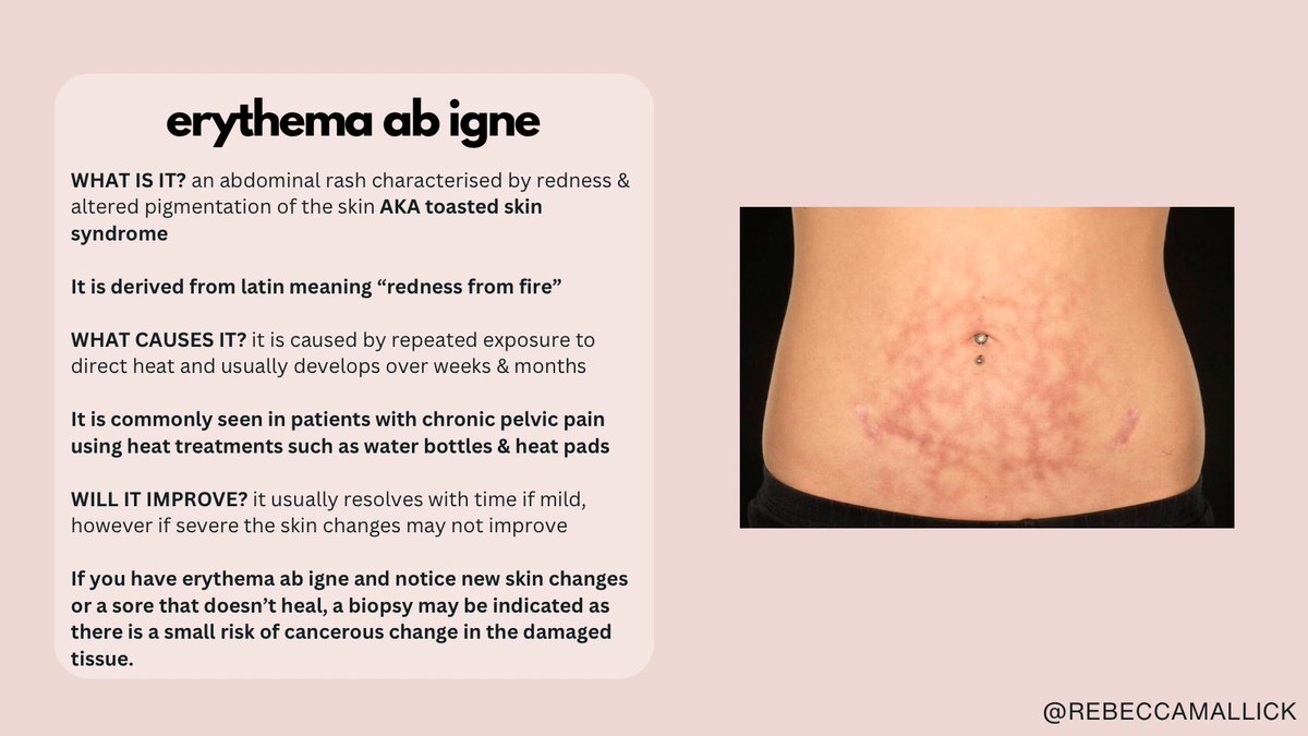 Spot on everyone - erythema ab igne aka toasted skin syndrome 

Also aka grannys tartan - thanks @stuie17 👍

I see this so often in chronic pelvic pain patients - have a read 👇👇
#endometriosis 
#adenomyosis
#pelvicpain