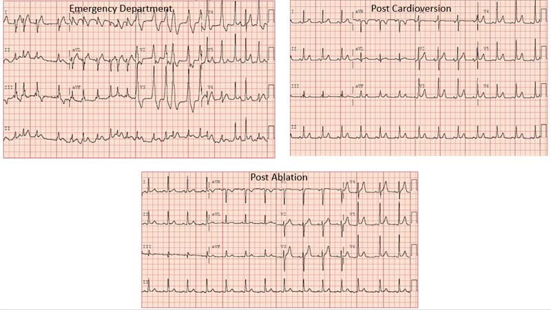 WPW,Afib-rapid ER diagnosis-EKG teaching-Dr.Noel Boyle @shivkumarmd @datsunian @ducdoMD @uclaCVfellows, TEE cardioversion #echofirst EP referral>>ablation 🔥🪄 @theheartorg @CardioNerds @Dr_LohitG @TheRhythmDoc @rajeshkabramd @aaeminfo @ACCinTouch @CircAHA @escardio @LITFLblog