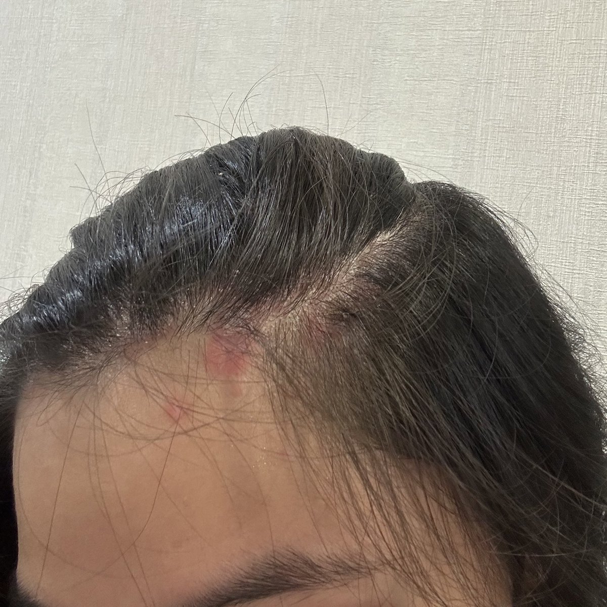 mapascarlett's tweet photo. Hello, rainy season! Hello Psoriasis flare ups 🥲 I've been sick also for the past 2 weeks with cough &amp; colds, so that's just made things worse so far.

Been getting weird looks again, but it's not like I'm not used to it by now. It's so much worse on my body.. it's hard... https://t.co/NM3yzQk3GR