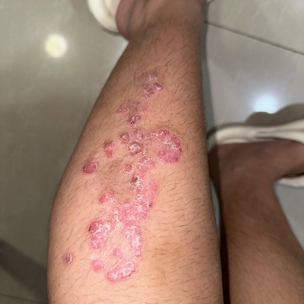 mapascarlett's tweet photo. Hello, rainy season! Hello Psoriasis flare ups 🥲 I've been sick also for the past 2 weeks with cough &amp; colds, so that's just made things worse so far.

Been getting weird looks again, but it's not like I'm not used to it by now. It's so much worse on my body.. it's hard... https://t.co/NM3yzQk3GR