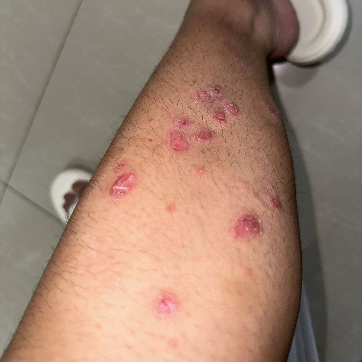 mapascarlett's tweet photo. Hello, rainy season! Hello Psoriasis flare ups 🥲 I've been sick also for the past 2 weeks with cough &amp; colds, so that's just made things worse so far.

Been getting weird looks again, but it's not like I'm not used to it by now. It's so much worse on my body.. it's hard... https://t.co/NM3yzQk3GR