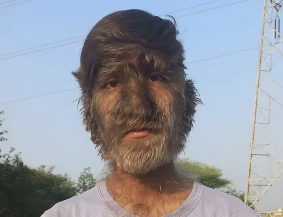 A teenager from Madhya Pradesh, India has an ultra rare condition called 'werewolf syndrome' (hypertrichosis). This uncurable condition is so rare that it is believed that only 50 people have had it since the Middle Ages.